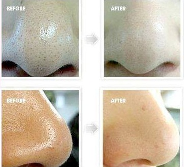 Mặt nạ bạc hà giảm mụn Queen Helene Mint Julep Masque