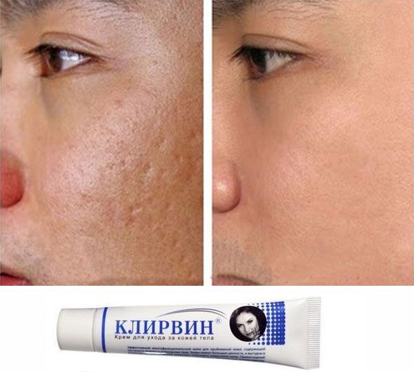 Kem sẹo Klirvin - Xóa mờ sẹo, thâm của Nga
