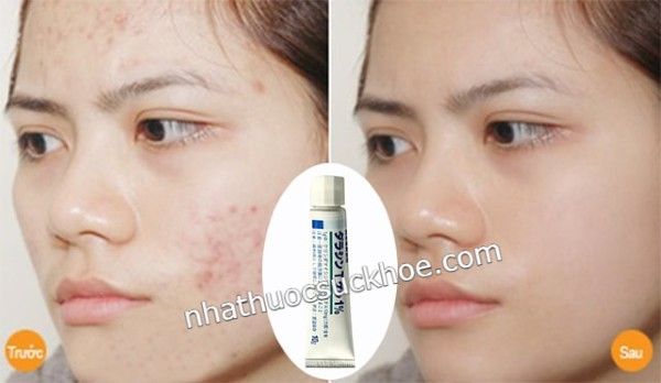 Kem hỗ trợ cải thiện mụn T Gel của Nhật Bản