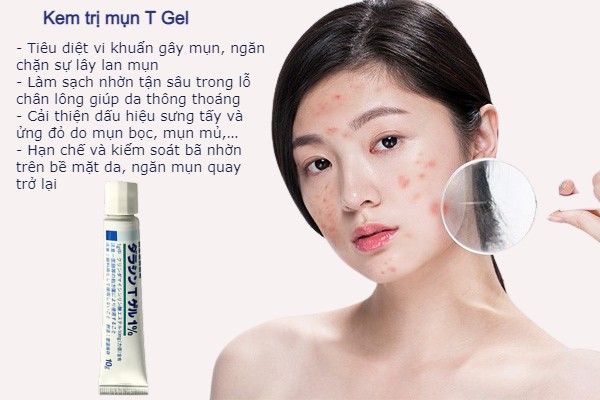 Kem hỗ trợ cải thiện mụn T Gel của Nhật Bản