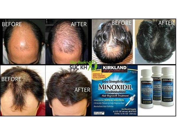 Minoxidil Kirkland 5% dung dịch kích thích mọc tóc chính hãng Mỹ, Giá tốt