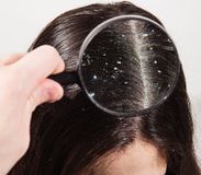 Dầu gội Neutrogena TGel Therapeutic trị vảy nến da đầu