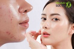 Skincare Routine Cho Da Dầu Mụn Hiệu Quả Cả Đông Lẫn Hè