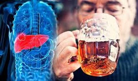 Viêm gan do rượu: Căn bệnh nguy hiểm đừng xem thường