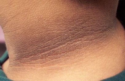Gai đen là bệnh gì? Nguyên nhân, biểu hiện, điều trị hiệu quả?