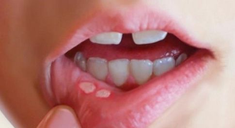 Lở miệng là gì? Hướng dẫn cách điều trị lở miệng dứt điểm