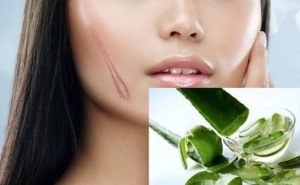 Bất ngờ với cách trị sẹo lồi tại nhà từ những nguyên liệu quen thuộc