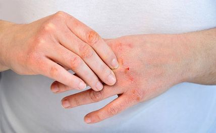 Bệnh viêm da cơ địa là gì? Có chữa khỏi được không? Cách phòng tránh ra sao?