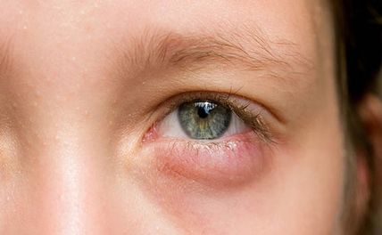Bệnh chắp mắt ở trẻ em: nguyên nhân, triệu chứng và cách điều trị