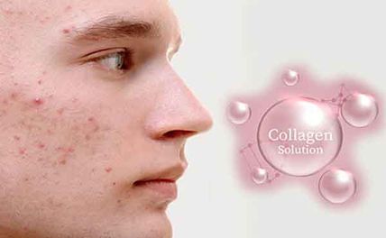 Uống collagen có bị nóng không? Bị nổi mụn thì phải làm sao?