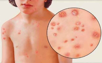 Nổi mẩn đỏ trên da là bị bệnh gì? Nguyên nhân và cách điều trị hiệu quả