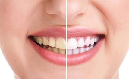 Top 18 cách làm trắng răng bị ố vàng hiệu quả không cần đến nha khoa 