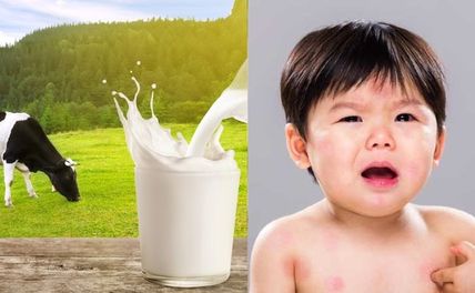 Dị Ứng Đạm Sữa Bò Ở Trẻ Em: Nguyên Nhân, Triệu Chứng, Cách Khắc Phục
