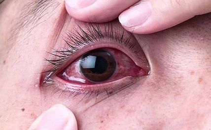 Các bệnh về mắt thường gặp: 18 bệnh cần cảnh giác kẻo mù lòa