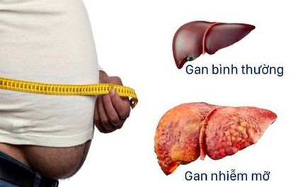 Gan nhiễm mỡ: Nguyên nhân, chẩn đoán, cách điều trị hiệu quả