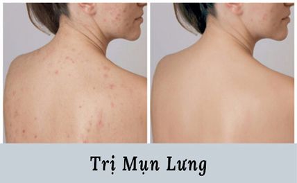 Top 7 cách trị mụn lưng tại nhà đơn giản, hiệu quả