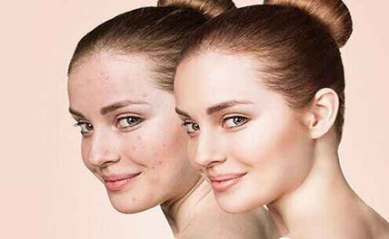 Hướng dẫn trị mụn bằng sữa chua giúp sạch mụn trắng da tại nhà