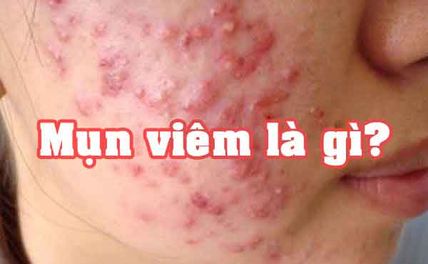 Mụn viêm là gì? Hướng dẫn điều điều trị nhanh chóng không để lại sẹo