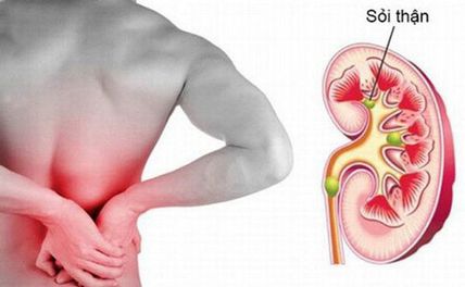 Bệnh sỏi thận: nguyên nhân, triệu chứng và cách phòng