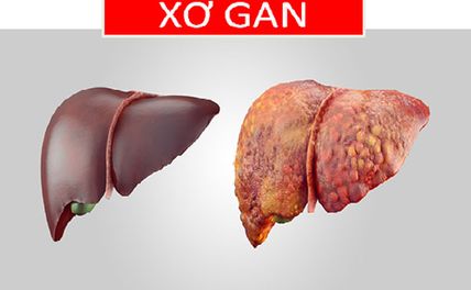 4 giai đoạn của bệnh xơ gan và biến chứng nguy hiểm cần biết