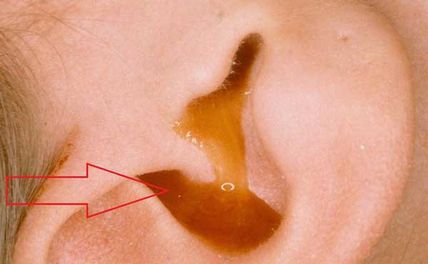 Bệnh viêm tai giữa: nguyên nhân, triệu chứng, cách điều trị và phòng tránh