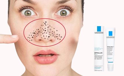 Top 5 kem trị mụn đầu đen hiệu quả tốt nhất nên mua