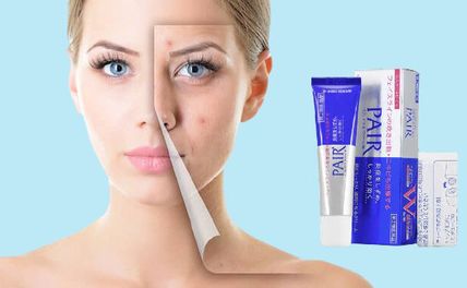Top 5 kem trị mụn Nhật Bản tốt nhất, đáng tiền nên mua 