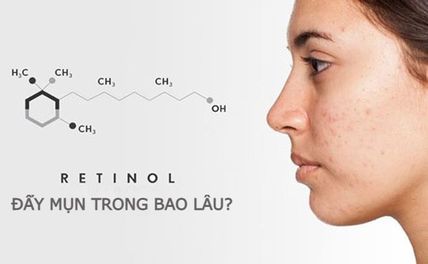 Retinol đẩy mụn trong bao lâu? Lưu ý chăm sóc da trong quá trình đẩy mụn