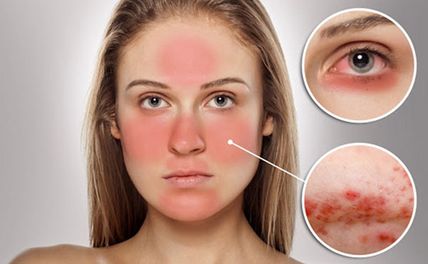 Dị ứng mỹ phẩm có tự hết không? Cách xử lý nhanh chóng hạn chế tổn thương da