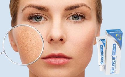 Review kem trị sẹo Hiruscar Post Acne có tốt không? Có trị được thâm mụn không?