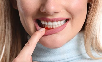 Bệnh nha chu là gì? Nguyên nhân, triệu chứng và cách điều trị 
