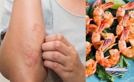 Dị ứng tôm: Dấu hiệu nhận biết nhanh và cách xử lý kịp thời
