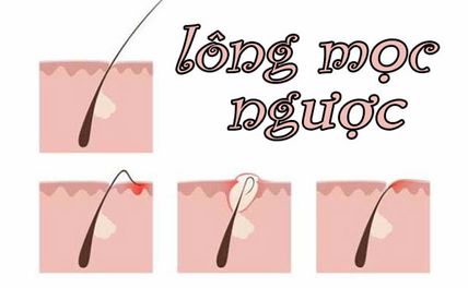 Lông mọc ngược phải làm sao? Cách xử lý an toàn và ngăn chặn lông mọc ngược