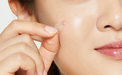 Miếng dán mụn là gì? Review Top 10 miếng dán mụn tốt nhất che đẩy mụn hiệu quả