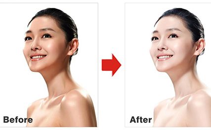 Truyền trắng da có hiệu quả không? Có an toàn không? Những điều cần biết