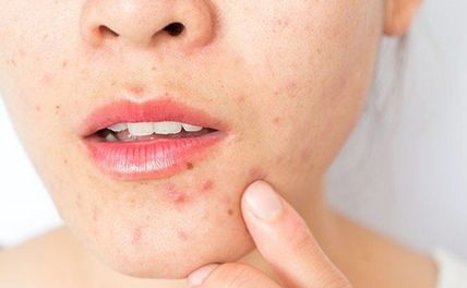 Các bước chăm sóc da khô mụn chuẩn nhất cho nàng có làn da khỏe đẹp
