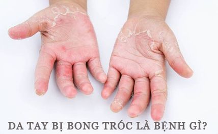 Da tay bị bong tróc là bệnh gì? Nguyên nhân và cách phục hồi da?