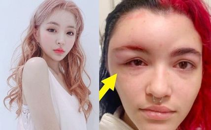 Dấu hiệu dị ứng thuốc nhuộm tóc và cách khắc phục nhanh chóng giảm ngứa rát