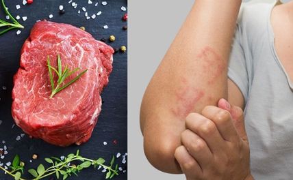 Dị ứng thịt bò phải làm sao? Dấu hiệu nhận biết và cách xử lý kịp thời?