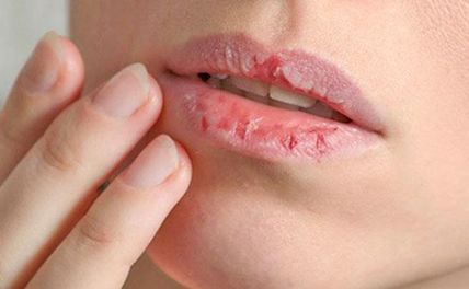 Môi khô nứt nẻ phải làm sao? 6 thói quen xấu gây khô môi chị em lưu ý  