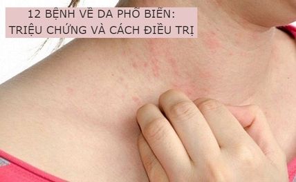 13 các bệnh về da thường gặp: triệu chứng và cách điều trị 