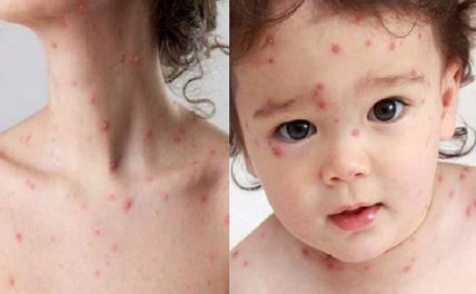 Bệnh đậu mùa là gì? Phân biệt thủy đậu và bệnh đậu mùa ở Việt Nam?
