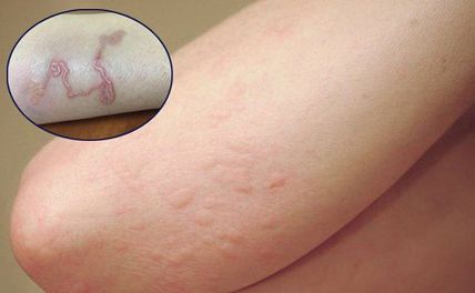 Bệnh sán chó có lây không? Triệu chứng bệnh sán chó ở người?