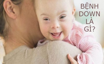 Nguyên nhân bệnh Down là gì? Bệnh Down sống được bao lâu? 