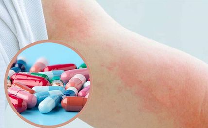 Nghiên Cứu Sử Dụng Thuốc Chống Dị Ứng Điều Trị COVID-19 Kéo Dài