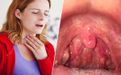 Top 10 thuốc trị viêm họng, đau họng hiệu quả người bệnh cần biết