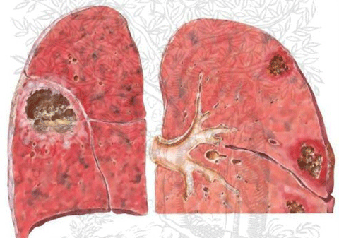 Bệnh phổi kẽ: Nguyên nhân, biểu hiện, phương pháp điều trị hiệu quả