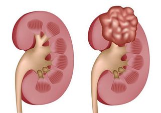 Hội chứng thận hư: Nguyên nhân, biểu hiện, phương pháp điều trị hiệu quả