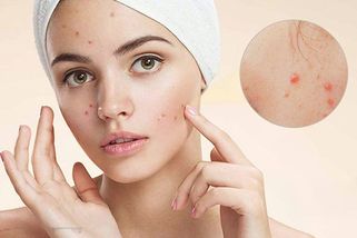 Dùng Trangala trị mụn được không? Phụ nữ mang thai có nên sử dụng?