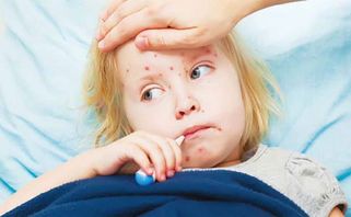Measles là gì? Có lây không? Dấu hiệu, cách điều trị và phòng ngừa?